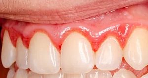 Tandvleesontsteking - gingivitis
