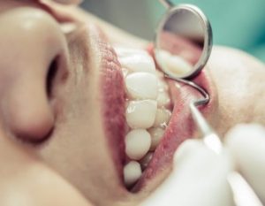 gaatje in tand of kies tandarts